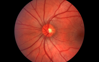 Glaucoma - A Silent Disease