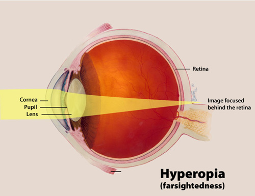 Diagram - Hyperopia