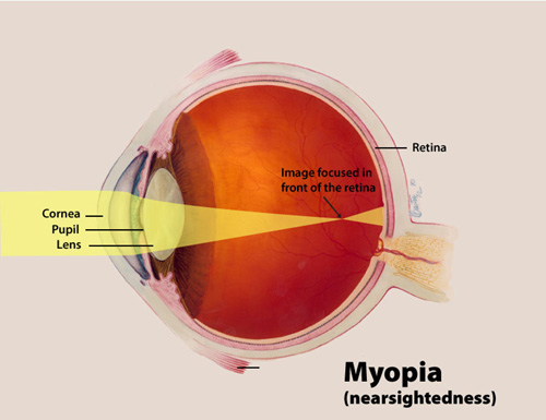 Diagram - myopia